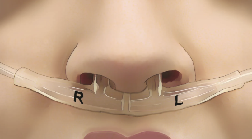    Трубки под носом измеряют поток воздуха из каждой ноздри. Это позволяет сформировать «дыхательный отпечаток» каждого человека