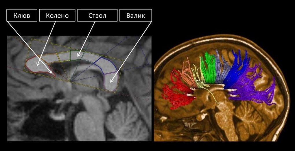 Анатомия мозолистого тела в сагиттальной проекции на МРТ крупным планом и 3D-реконструкция