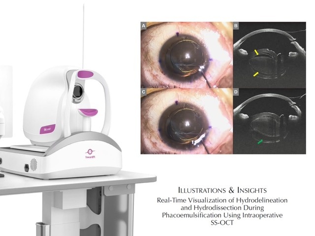 🔎 Факоэмульсификация с интраоперационным ОКТ-контролем

Использован прототип цифрового навигационного микроскопа с системой FullRange SS-OCT TowardPi (Китай)

В рубрике American Journal of Ophthalmology (Q1) вышла занятная публикация, где с помощью SS-OCT наглядно продемонстрировали суть этапов гидродиссекции (зелёная стрелка) и гидроделинеации (жёлтая)

Подробнее:

Интраоперационная SS-OCT у такого микроскопа имеет длину волны в 1060 нм и скорость сканирования в 100 000 A-сканов/сек

Глубина и ширина скана — 12 и 16 мм, разрешение — 2048 × 1536 px; B-скан синхронизирован с видеоизображением хирургии (60 кадров в секунду)

Визуальный признак «golden ring» (на фото) указывает на то, что ядро успешно отделилось от окружающего кортекса

Какой же профит? Думаю, что максимальная детализация хрусталикового комплекса в реальном времени будет важна в осложненных случаях.
