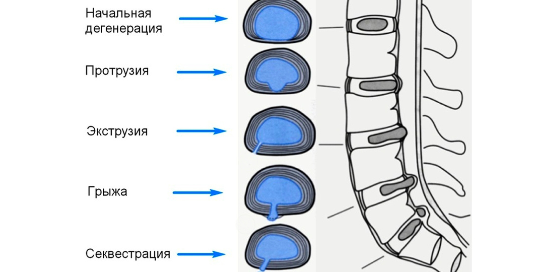 Протрузия без боли: стоит ли волноваться и что делать?
