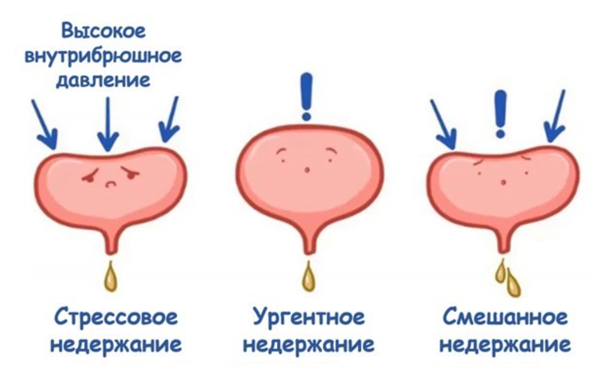 Типы недержания