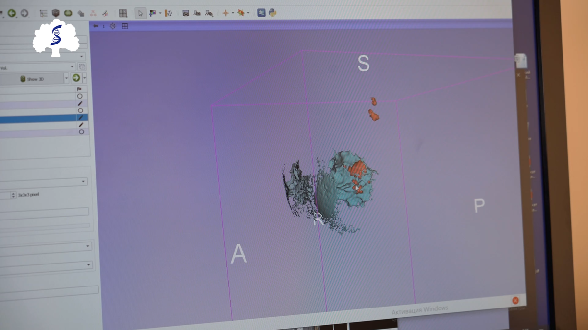   Интерфейс программы предоперационного 3D-моделирования. Опухолевая патология обозначается отдельным цветом