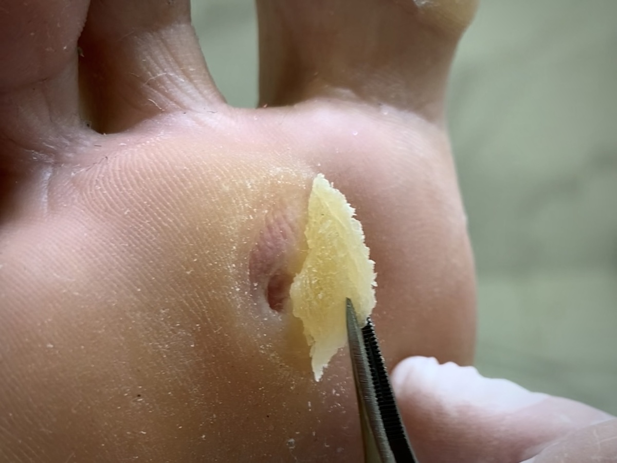 До какой глубины прорастает корень у сухой мозоли