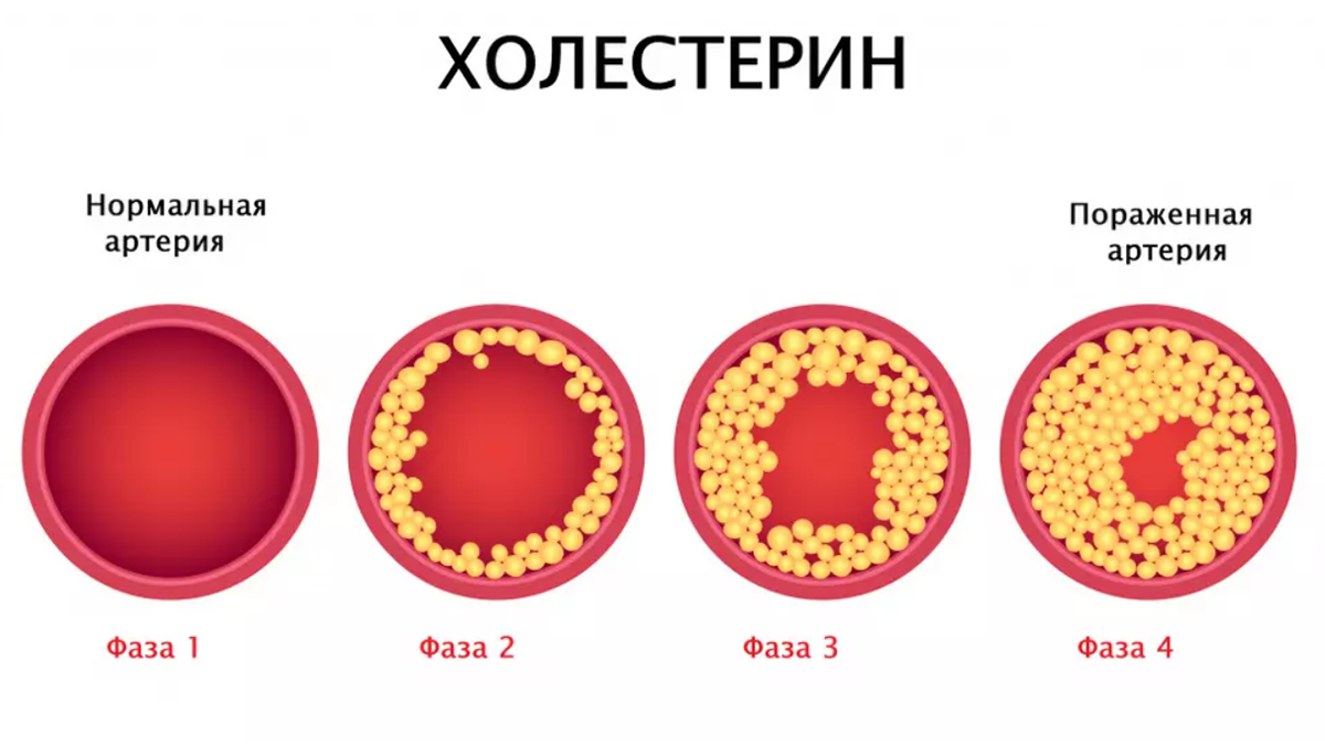 Холестерин После 60: Враг или Необходимая Защита? Разбор Популярных Мифов с Мнением Кардиолога