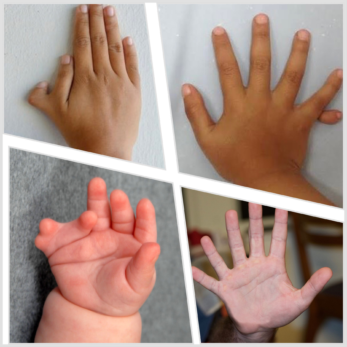 Полидактилия – самая часто встречающаяся патология среди новорожденных деток