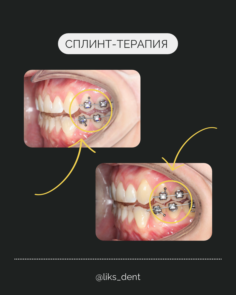 Процесс сплинт-лечения
