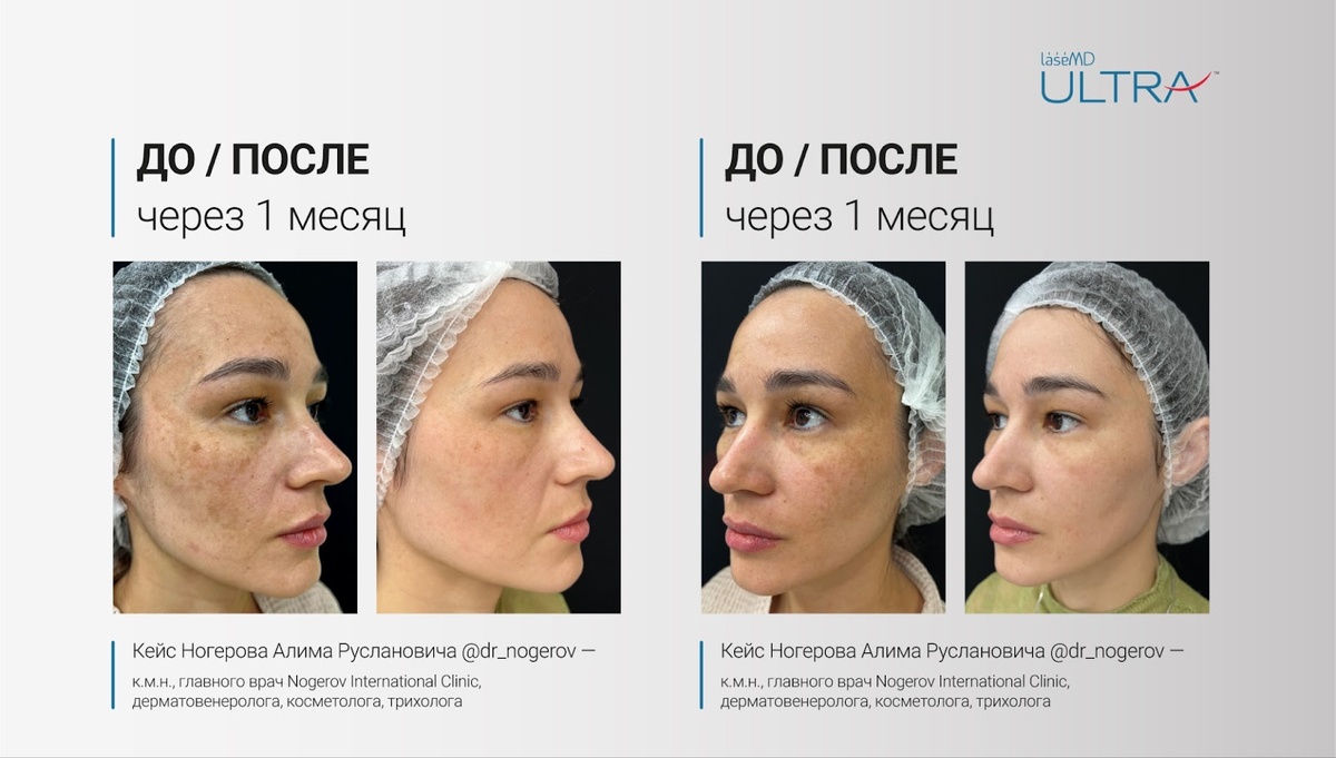 Клинический кейс – лечение мелазмы на аппарате ULTRA LaseMD