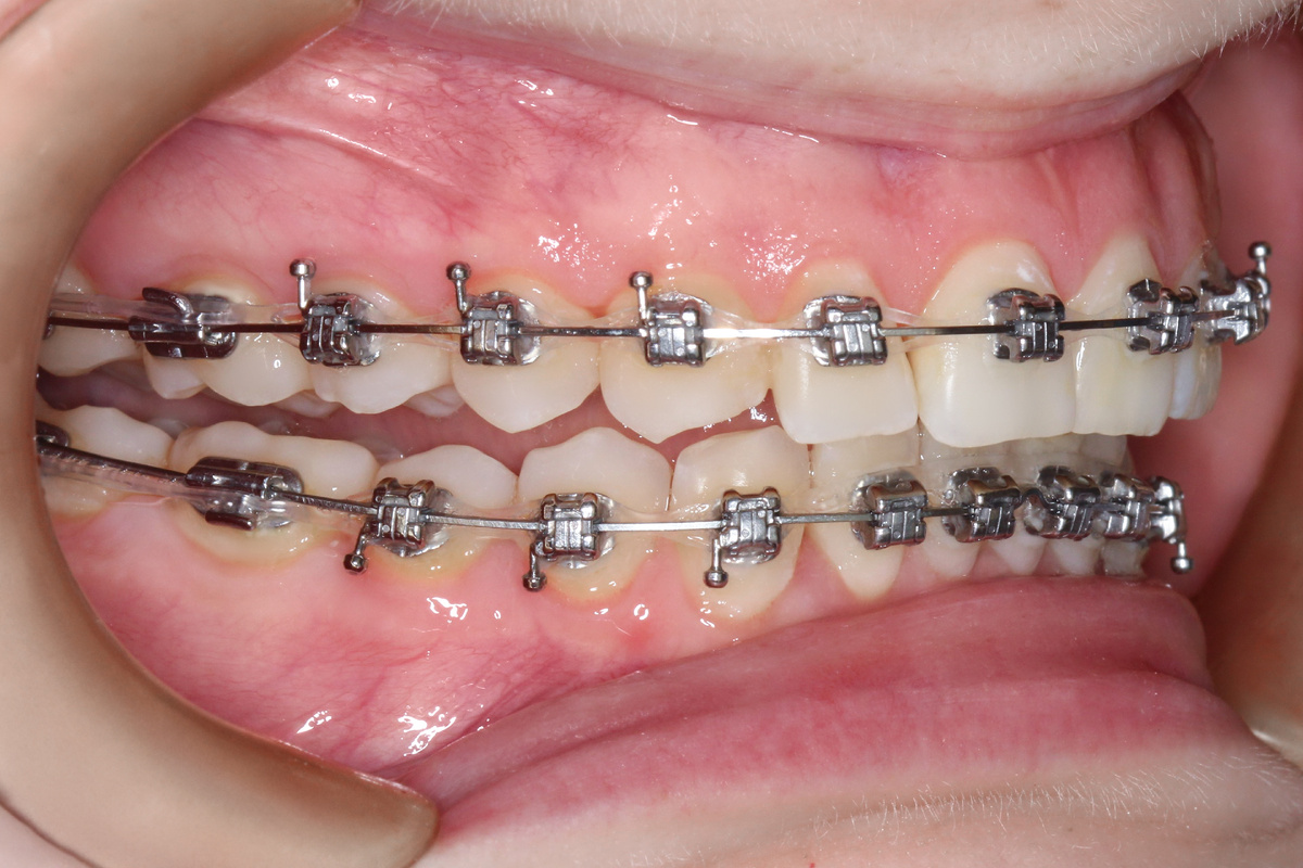 Расстояние между верхней и нижней челюстью