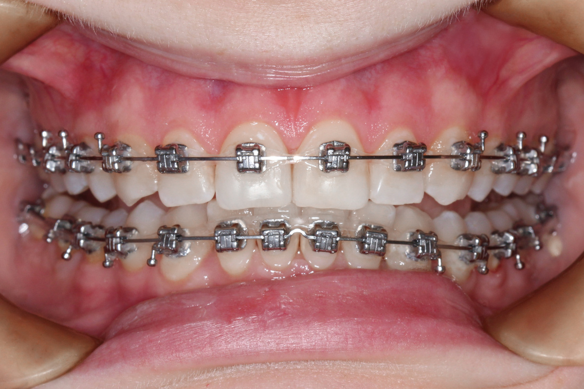 Визуально ровные зубы