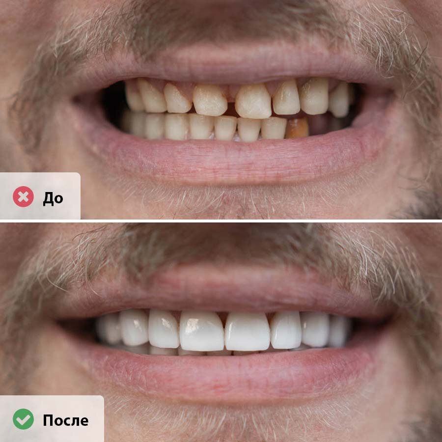 ИМЕЮТСЯ ПРОТИВОПОКАЗАНИЯ, НЕОБХОДИМА КОНСУЛЬТАЦИЯ СПЕЦИАЛИСТА