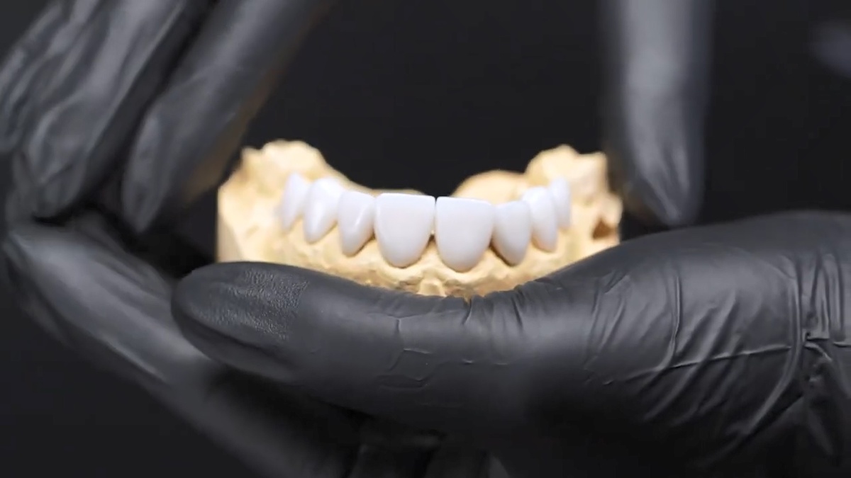 Реставрационные накладки могут быть установлены почти любому желающему при отсутствии прямых противопоказаний и физической невозможности их установки