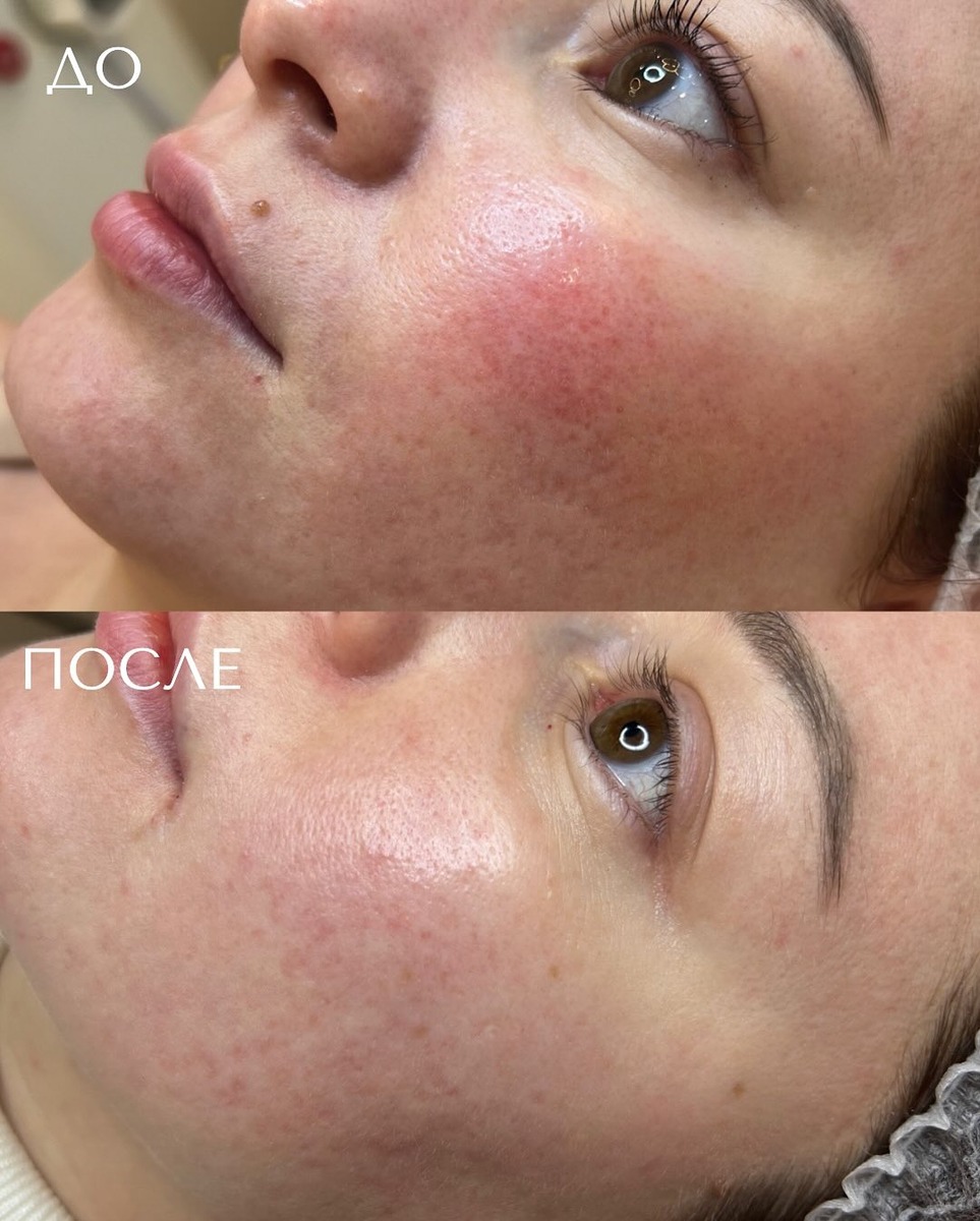 Результат фотолечения кожи 