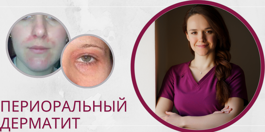 Периоральный дерматит