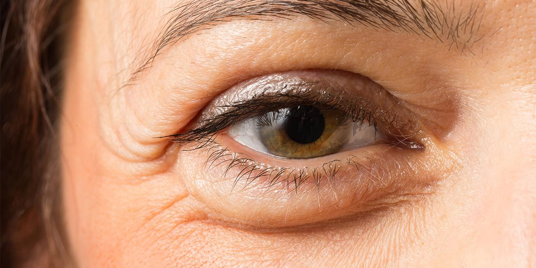 Долой мешки под глазами! Как пластическая хирургия побеждает эту проблему и какие сюрпризы готовит после операции?