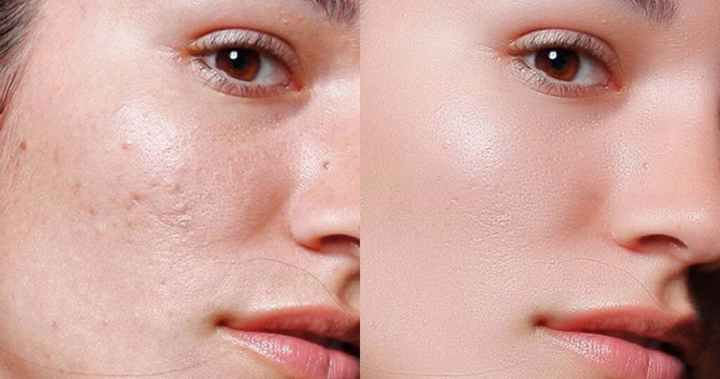 Чистая кожа без прыщей: как правильно пользоваться косметикой и организовать грамотный уход?