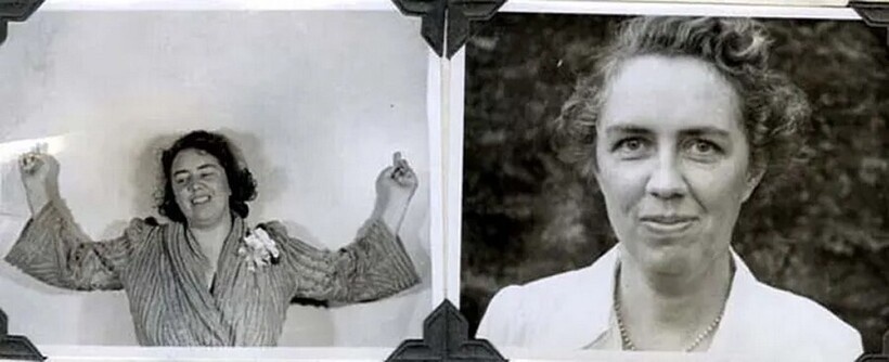    До и после лоботомии: 15 тревожных снимков, как эта процедура изменила жизнь навсегда