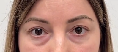 До операции