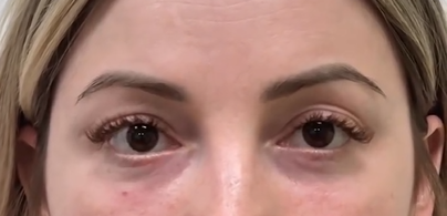 Спустя 2 месяца после операции