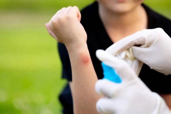 Когда комариный укус требует немедленного обращения к врачу. Фото © Shutterstock / FOTODOM / DocPhotos