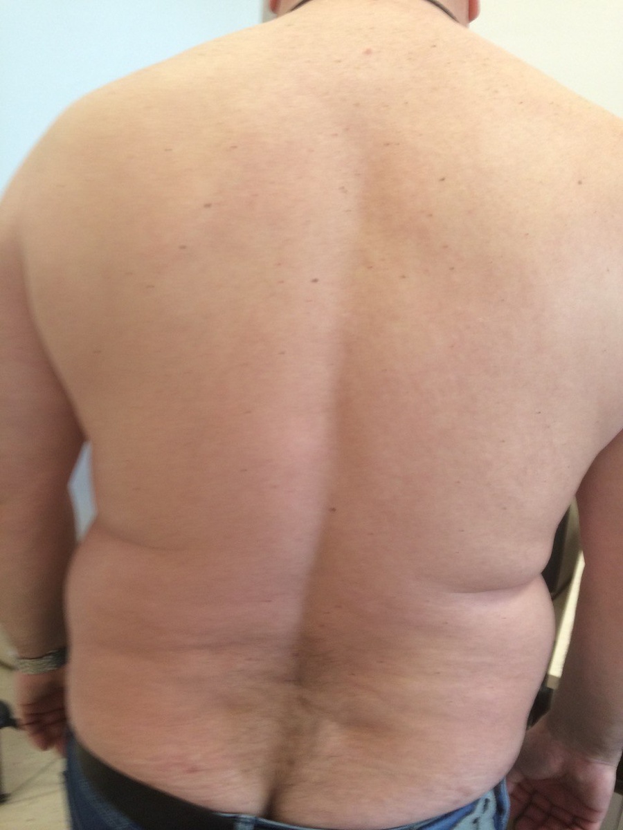 Фото псориаза через 4 месяца терапии у мужчины 52 -х лет. Из личной практики врача-дерматовенеролога Биткиной О. А.