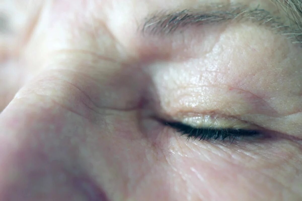    Дерматолог Пашкова объяснила, как предотвратить появление мелких морщин