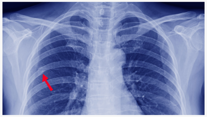 Пример перелома ребра на КТ ОГК. Источник: радиологичнеский атлас.