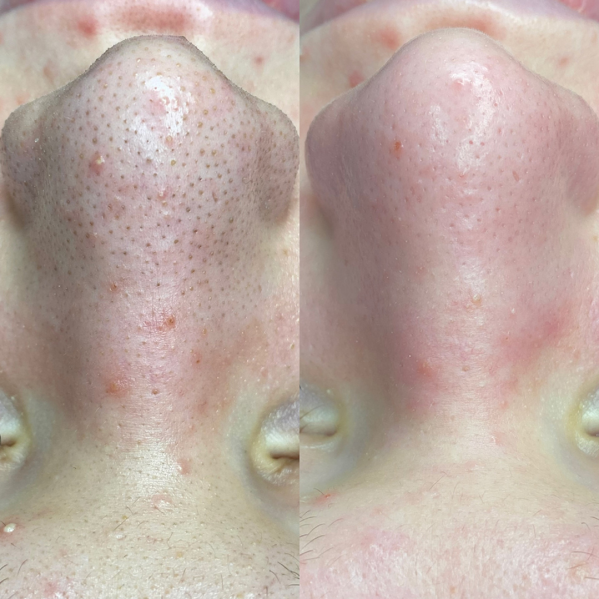 Результат комбинированной чистки лица 