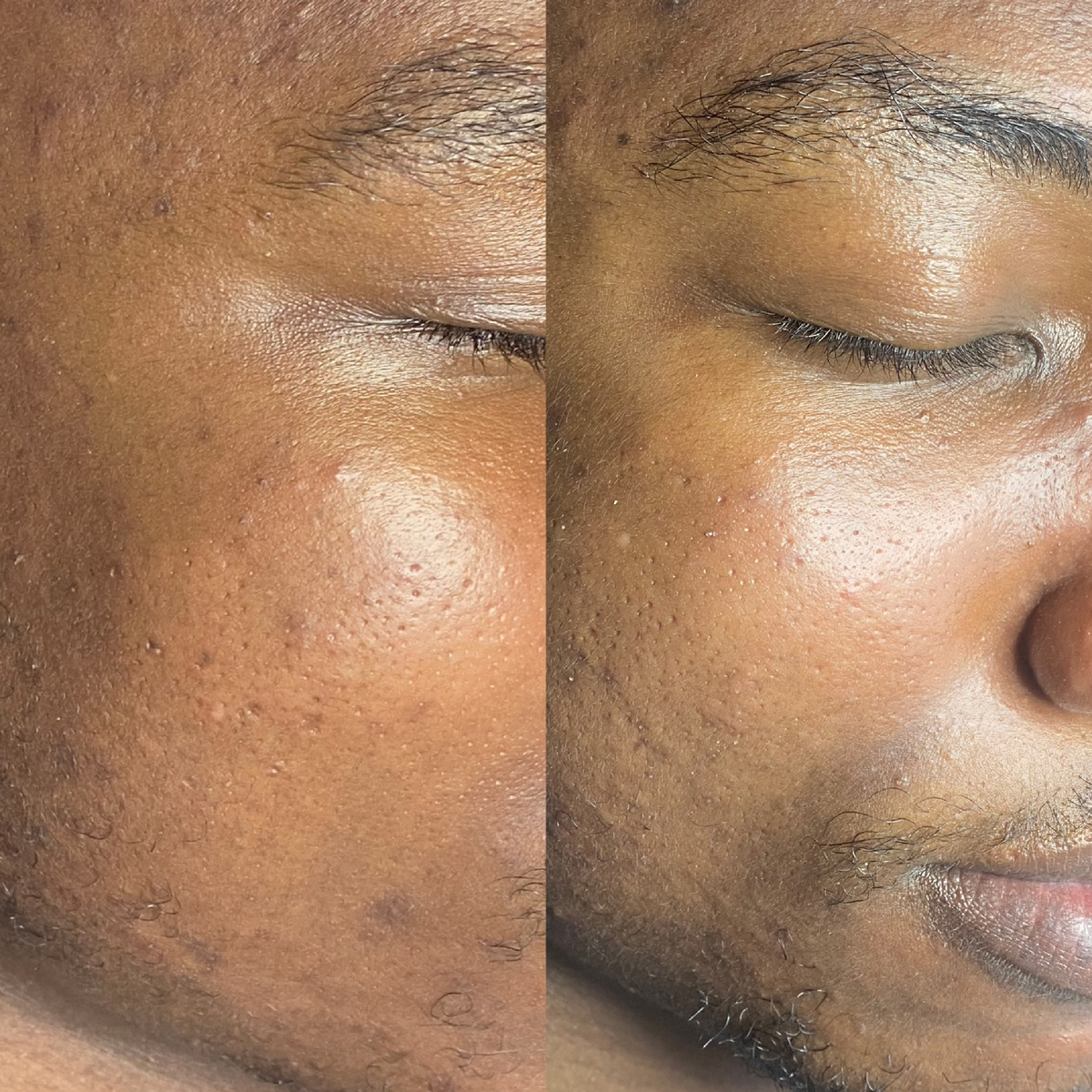 До / после комбинированной чистки лица 