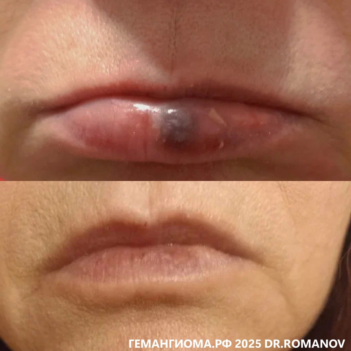 Проведен 1 сеанс сосудистого лазера Cutera Excel V в Центре сосудистой патологии "Гемангиома"