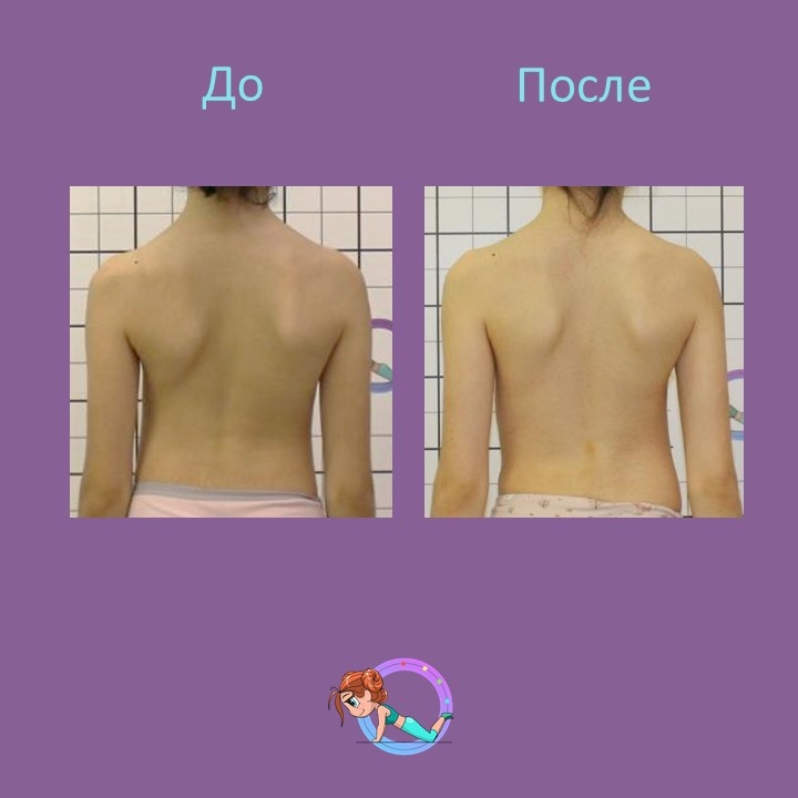 
Пациентка Д. 2011 г.р. обратилась на приём к врачу ортопеду к.м.н. 👨🏻‍⚕️ Шавырину И.А. с жалобами на деформацию позвоночника
При осмотре поставлен диагноз: юношеский идиопатический 
сколиоз 3 степени 
Было пройдено лечение: корсетотерапия по методу Шено и гимнастика по методу К.Шрот
На сегодняшний момент в корсете Шено угол деформации уменьшен с ⚡️28 до 5⚡️ в грудном отделе и с ⚡️23 до 5⚡️в поясничном 👏🏼
❗️Коррекция в корсете 80% ❗️
Так же получен хороший косметический результат👍🏼