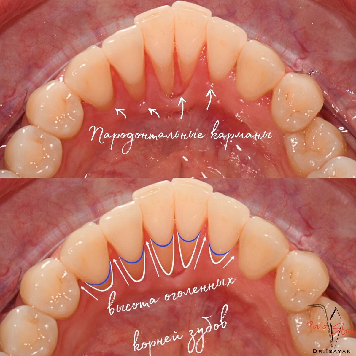 На фото ситуация "До", с которой пациент обратился в наш Пародонтологический Центр.