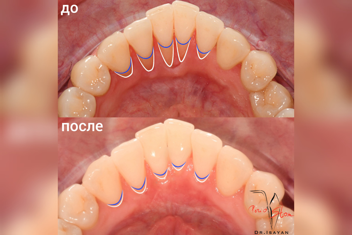 На фото "После" виден отличный стабильный результат через 6 месяцев после проведённой операции.