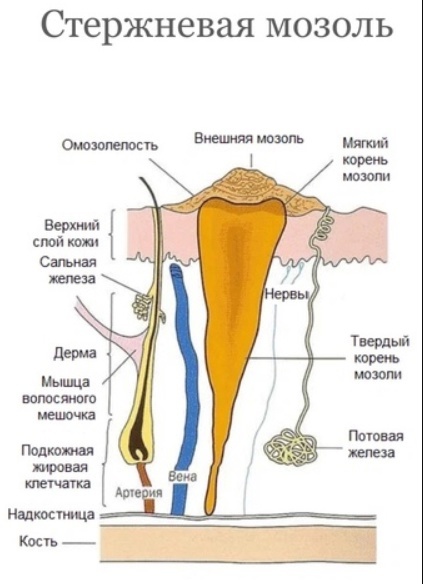 Стержневая мозоль, строение