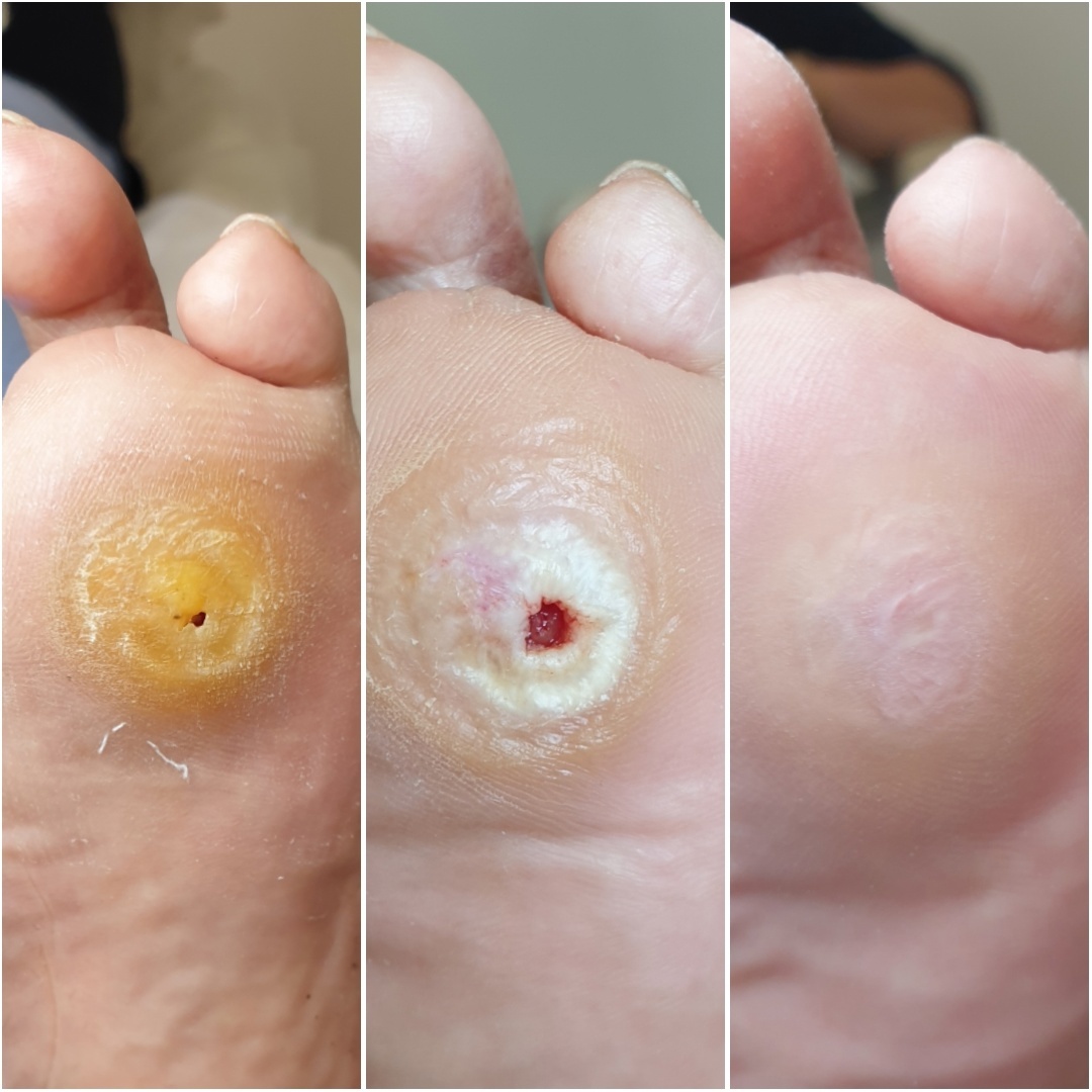 До и после обработки и заживления стержневой мозоли.