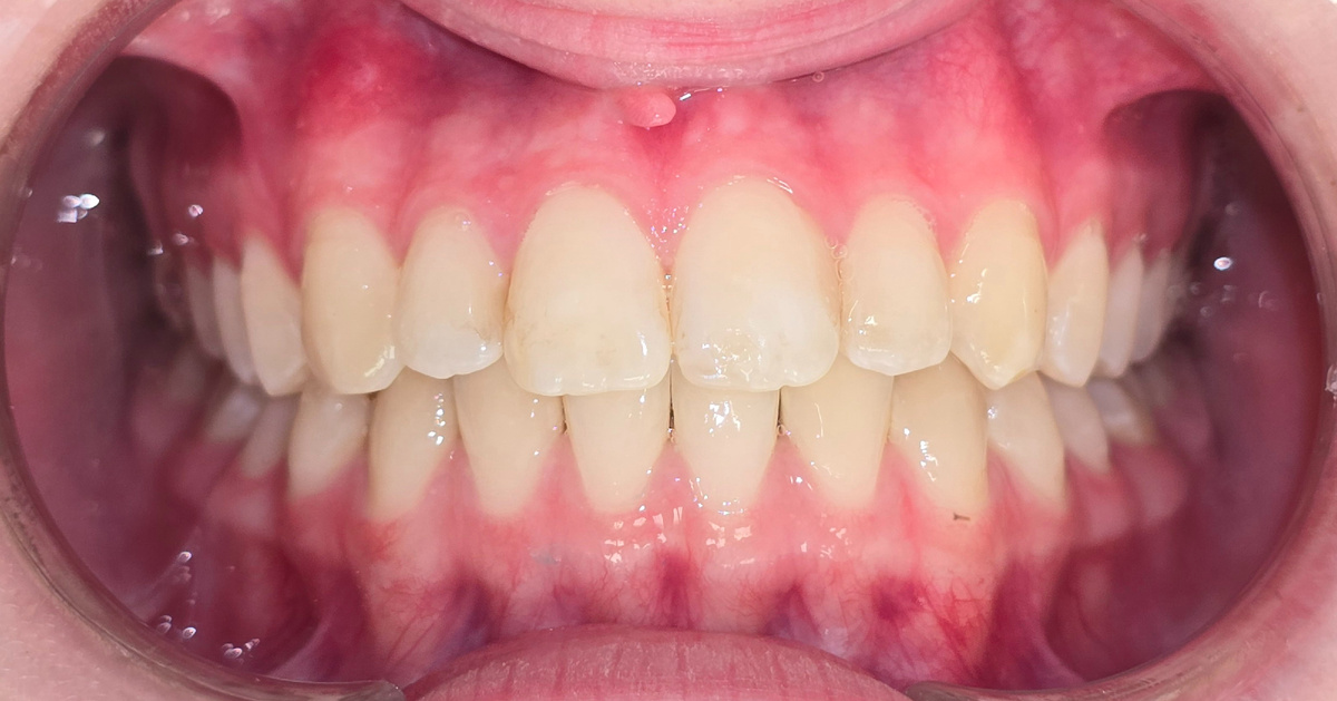 Результат после снятия брекетов спустя год.