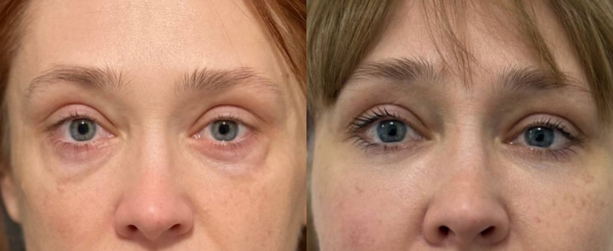 Трансконъюнктивальная блефаропластика и липофилинг средней зоны лица фото до и после. Фото с сайта хирурга Д.Р. Гришкяна. Имеются противопоказания, требуется консультация специалиста