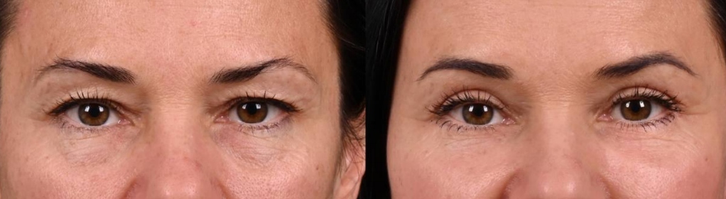 Трансконъюнктивальная блефаропластика и липофилинг. Фото до и после. Фото с сайта хирурга Д.Р. Гришкяна. Имеются противопоказания, требуется консультация специалиста
