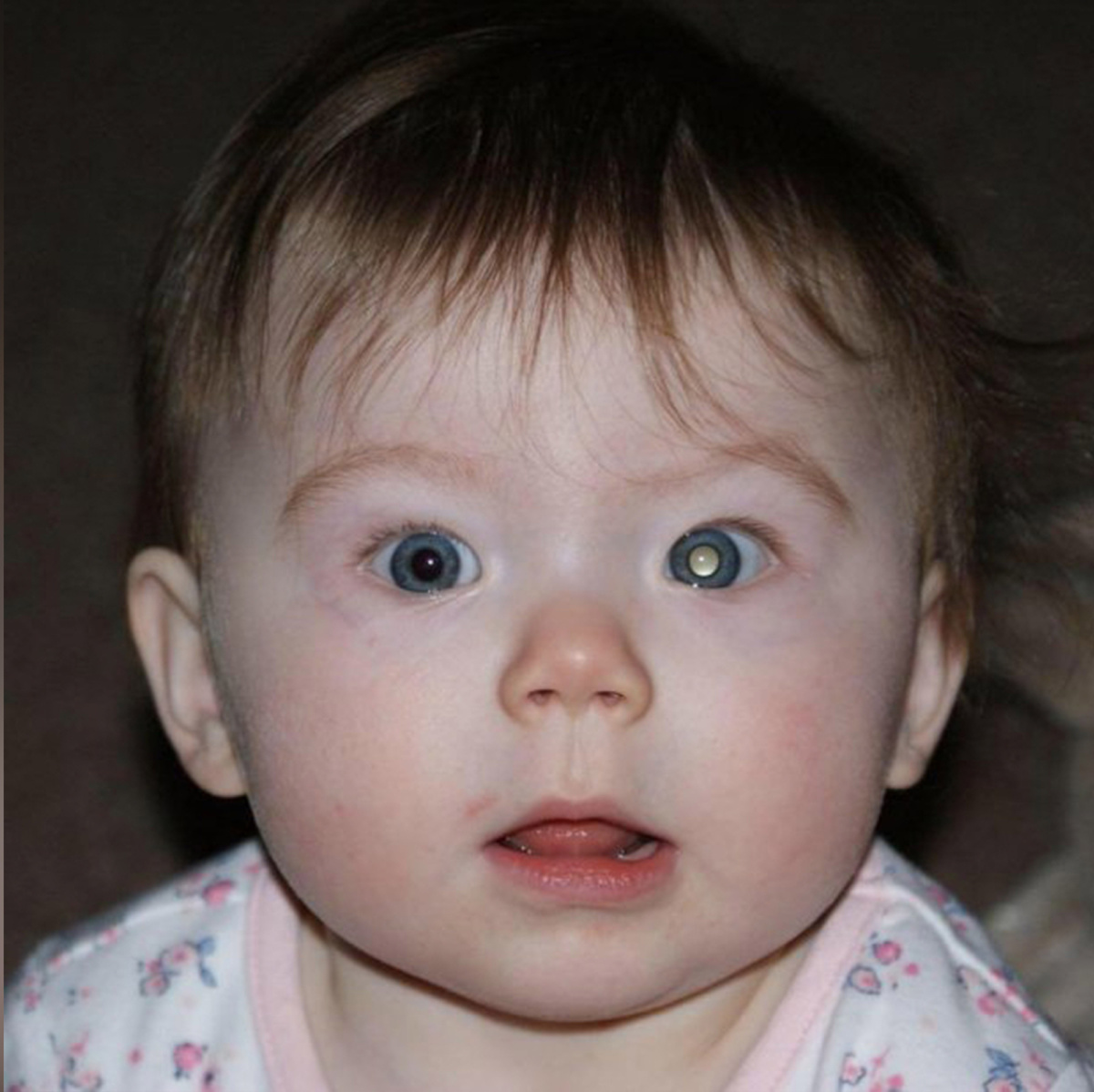  Самый часто замечаемый симптом ретинобластомы - лейкокория (белое "свечение" зрачка)