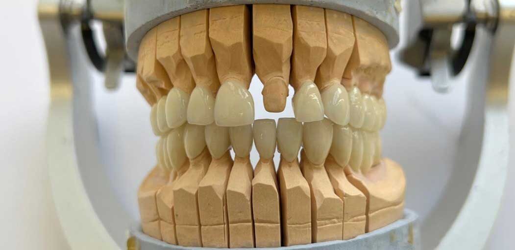Конструкция из диоксида циркония, облицованная керамической массой Noritake CZR
