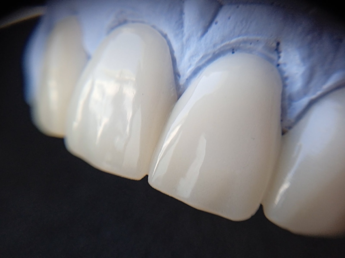 Временная конструкция из PMMA изготовленная по технологии CAD/CAM 