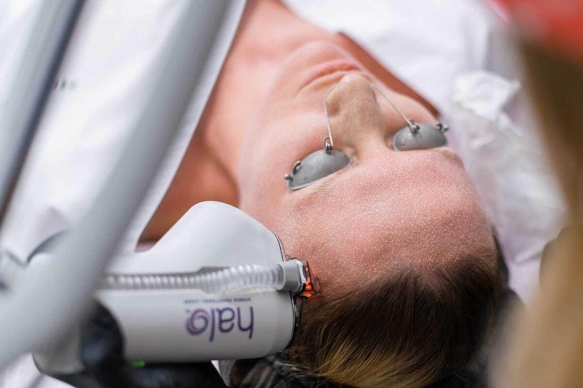 Лазерное омоложение HALO