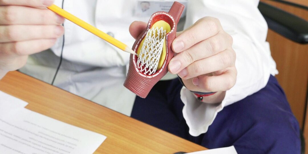 Жизнь после стентирования — что меняется и как сохранить здоровье сердца