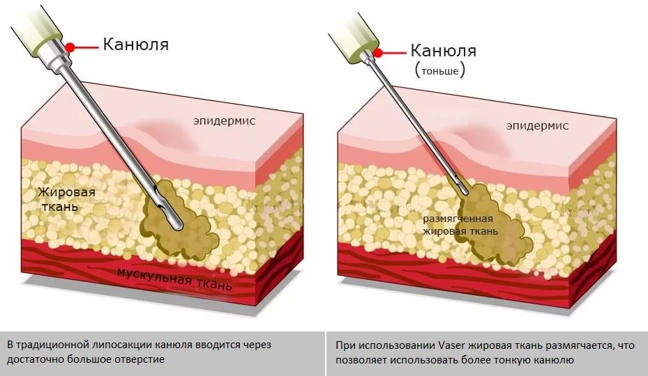 Липосакция: Чудо пластической хирургии или лотерея?