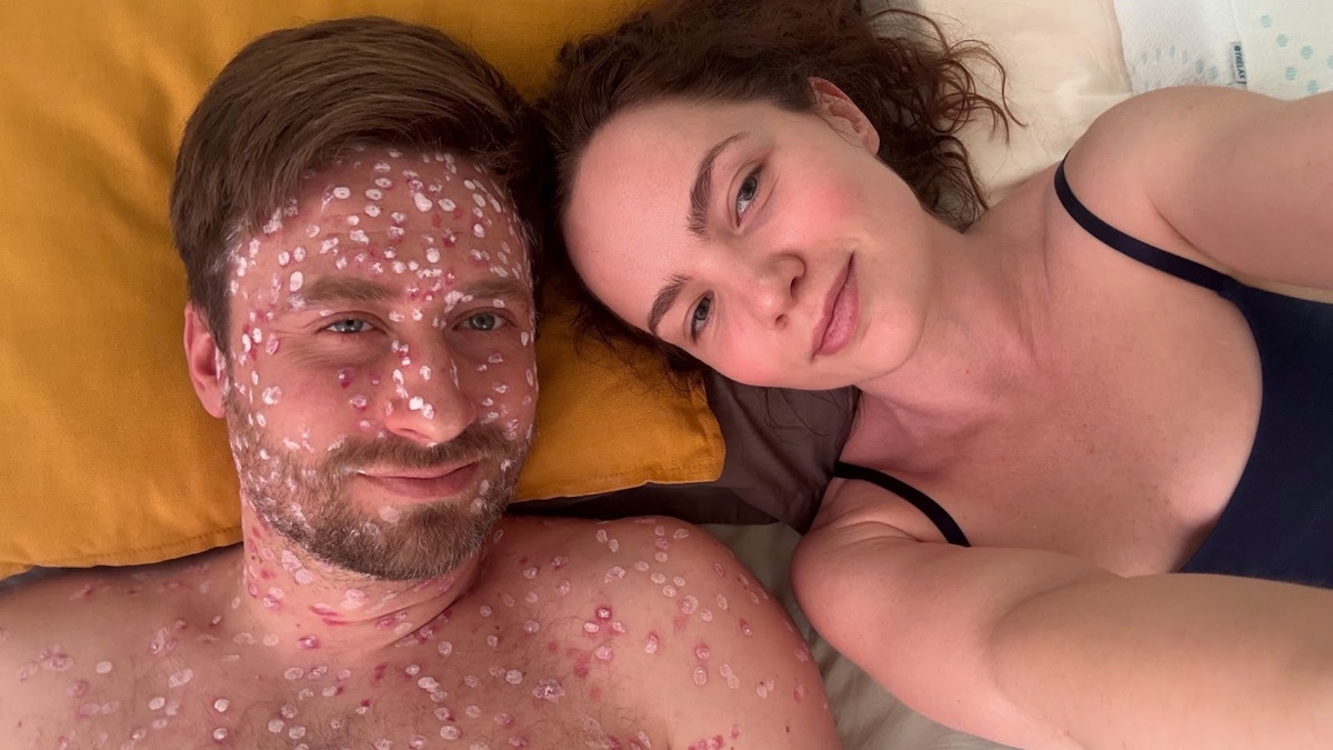 Белые пятнышки – это каламин