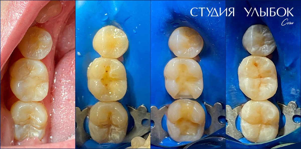 Фото поэтапно - лечение среднего кариеса зубюов 46,47