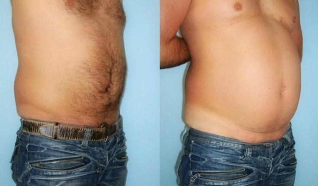 Так выглядит висцеральный жир.
