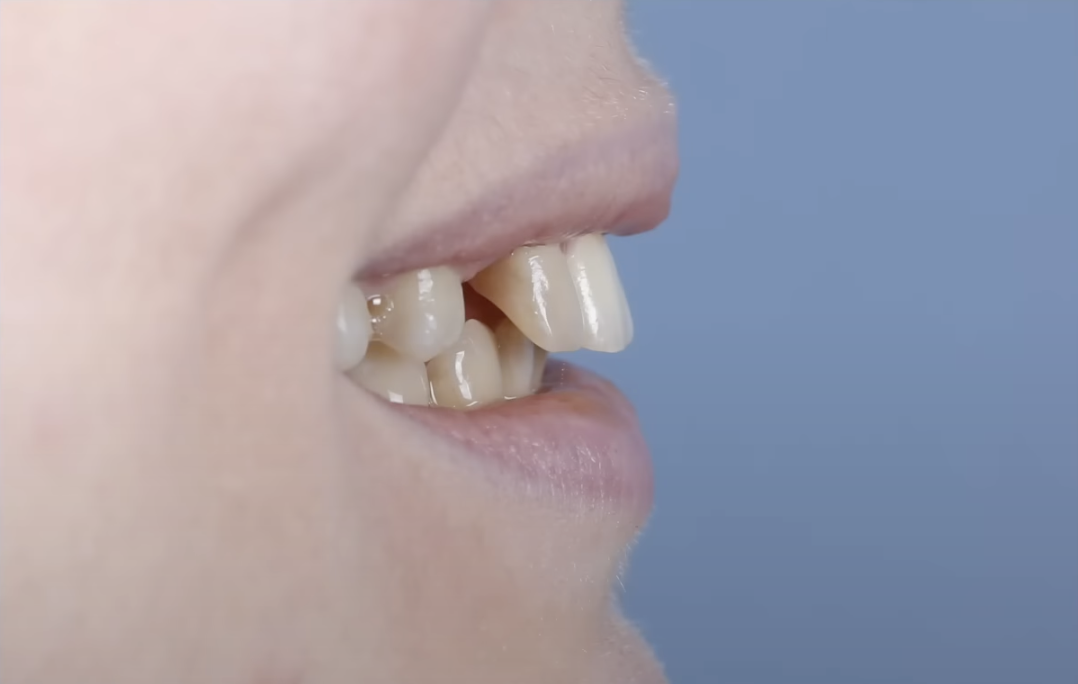 Передние зубы выперло вперед