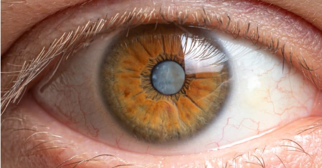 Катаракта: когда пора на операцию и как выбрать подходящую линзу?