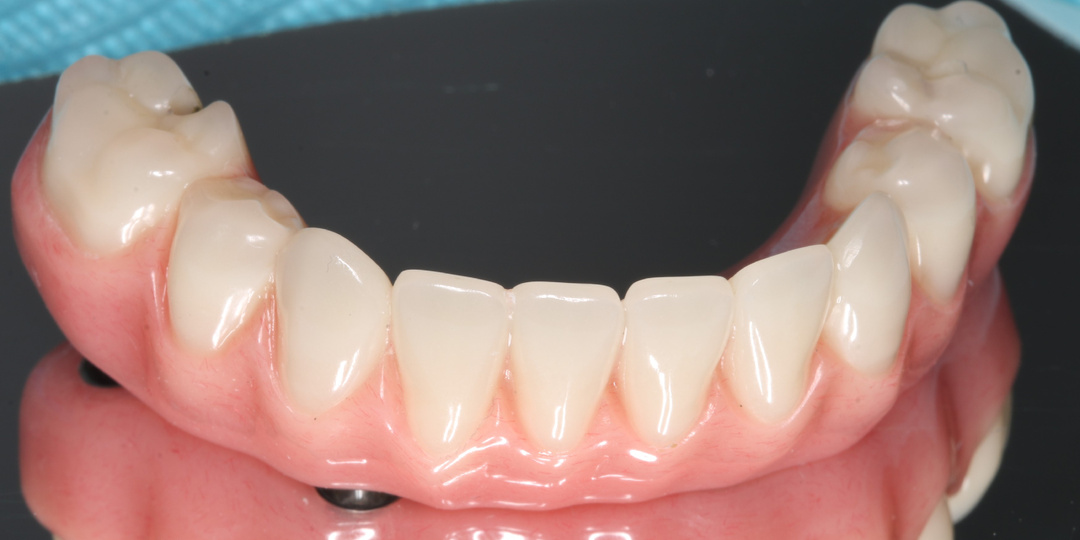 Протезы с опорой на четыре импланта: про комфорт, стоимость и показания