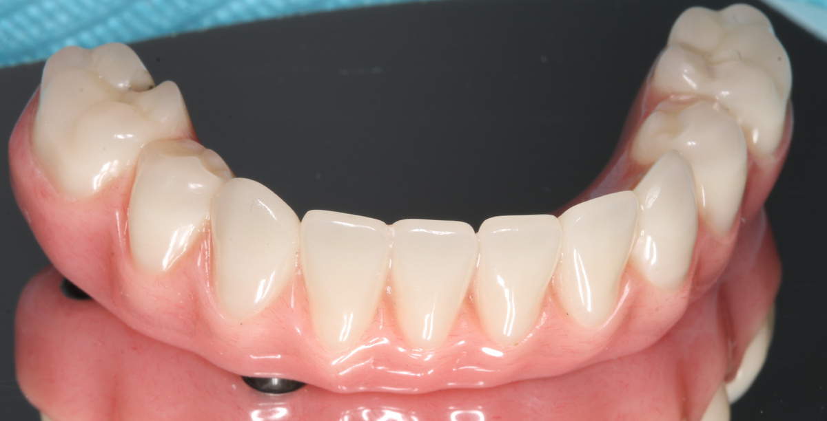 Так выглядит адаптационный протез на нижней челюсти. Подробности ниже.